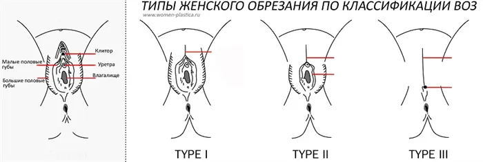 Типы обрезания половых губ у женщин по классификации ВОЗ