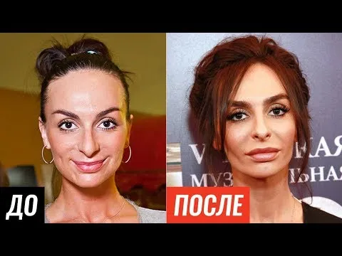 ЗВЕЗДЫ ДО И ПОСЛЕ ПЛАСТИКИ. Знаменитости, которых не узнать на старых фото